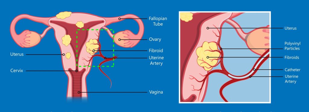 an illustration of fibriods and how they can affect the uterine arteries. inset illustration shows how Uterine Artery Embolisation works an illustration of fibriods and how they can affect the uterine arteries. inset illustration shows how Uterine Artery Embolisation works