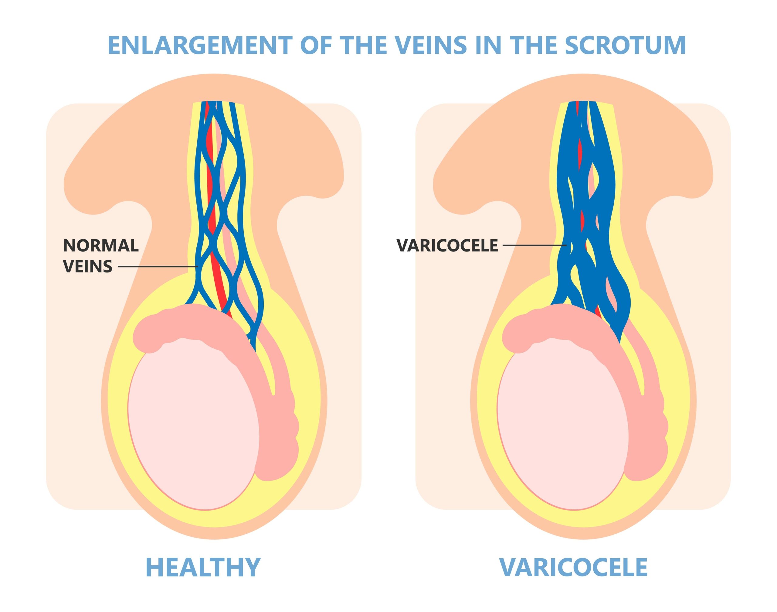 Illustration of what enlarged veins in the scrotum, causing varicocele would look like Illustration of what enlarged veins in the scrotum, causing varicocele would look like