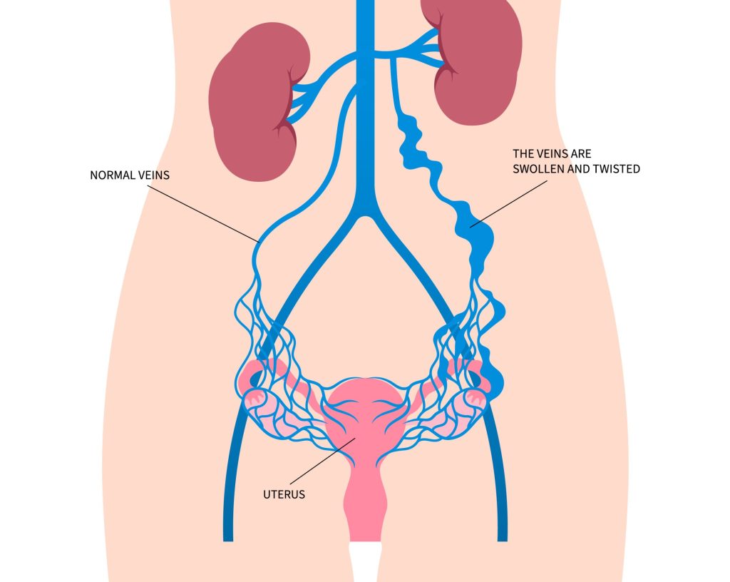 am illustration of pelvic venous congestion and how it may look compared to normal veins am illustration of pelvic venous congestion and how it may look compared to normal veins